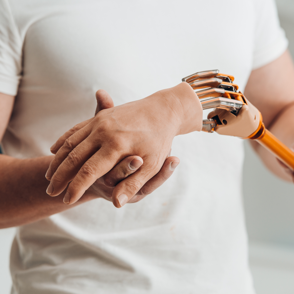 Eine Person trägt eine moderne Armprothese mit einer naturgetreuen Silikonhaut, die die mechanischen Finger überdeckt. 